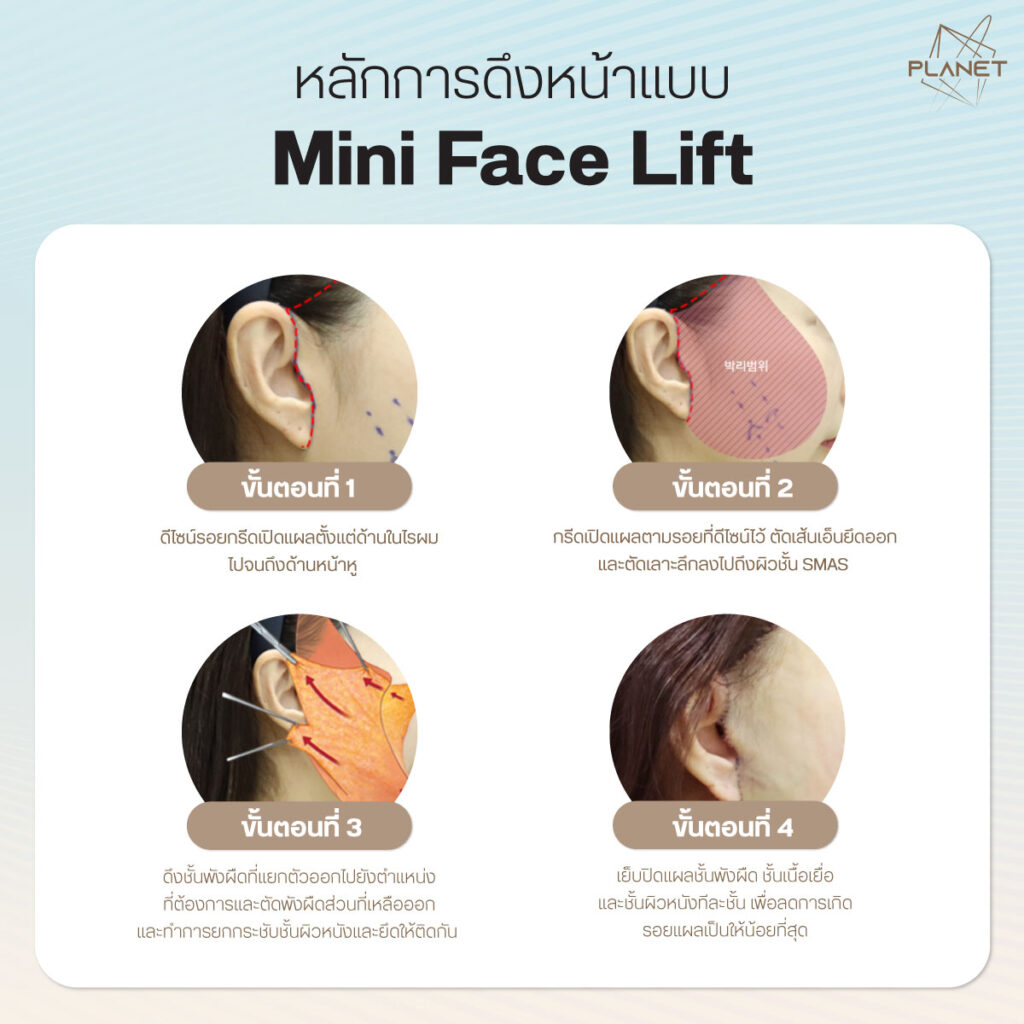 หลักการดึงหน้า Mini Face Lift_
